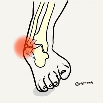 발목골절 발목염좌