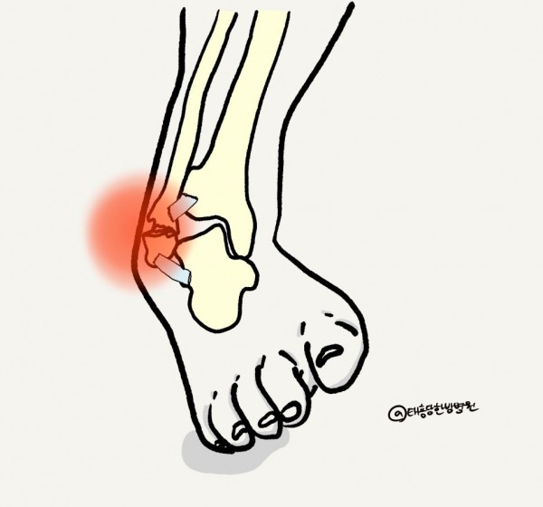 발목골절 발목염좌