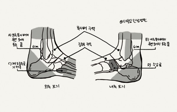 발목골절 발목염좌
