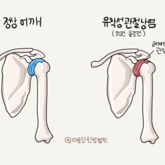 유착성관절낭염 오십견 