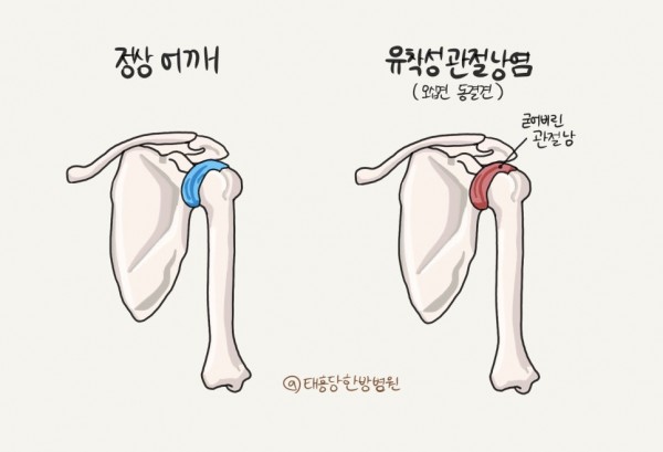 유착성관절낭염 오십견