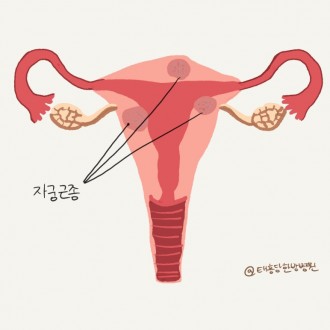 자궁근종 수술 후 회복