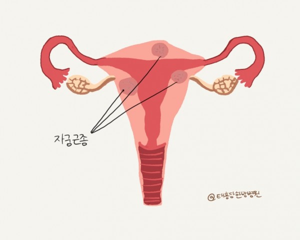 자궁근종 수술 후 회복