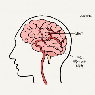 뇌동맥류 수술 후 재활