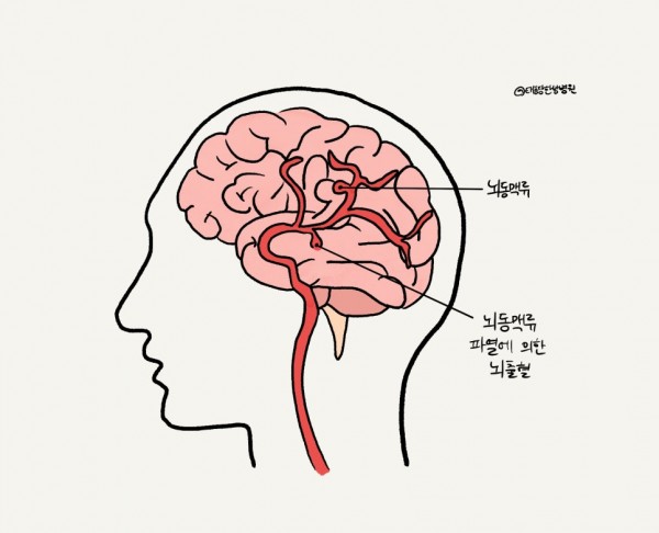 뇌동맥류 수술 후 재활