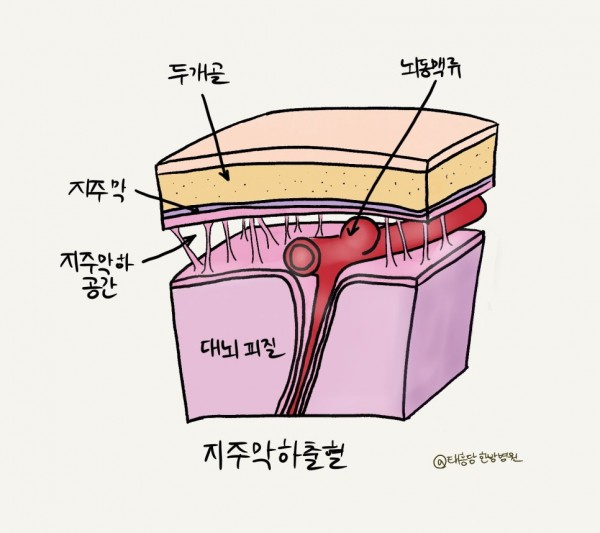 뇌동맥류 수술 후 재활