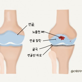 무릎 퇴행성 관절염 재활치료