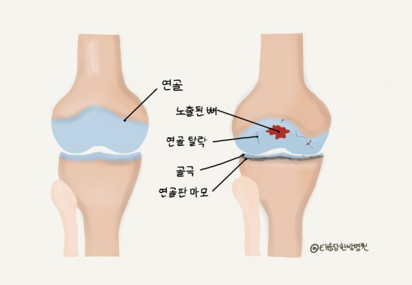무릎 퇴행성 관절염 재활치료