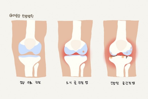 무릎 퇴행성 관절염 재활치료