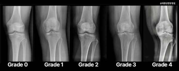 무릎 퇴행성 관절염 재활치료