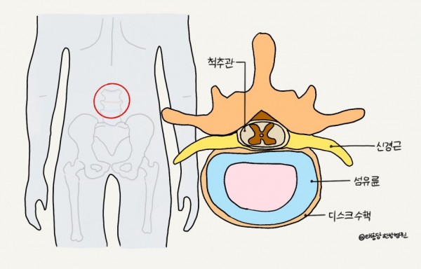 척추수술실패증후군