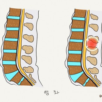 외상성 척추 손상 수술 후 재활