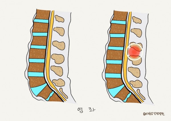 외상성 척추 손상 수술 후 재활