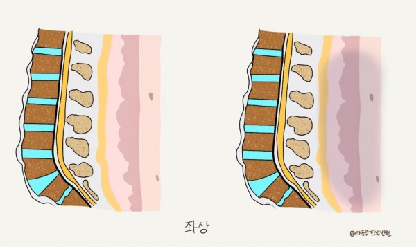 외상성 척추 손상 수술 후 재활