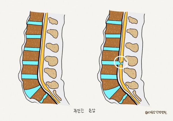 외상성 척추 손상 수술 후 재활