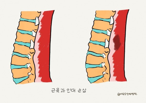외상성 척추 손상 수술 후 재활