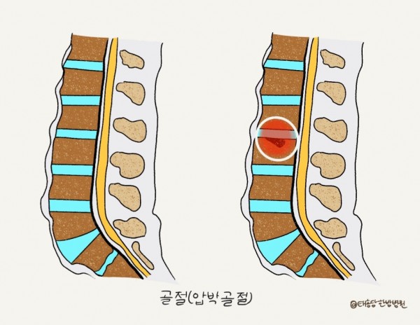 외상성 척추 손상 수술 후 재활