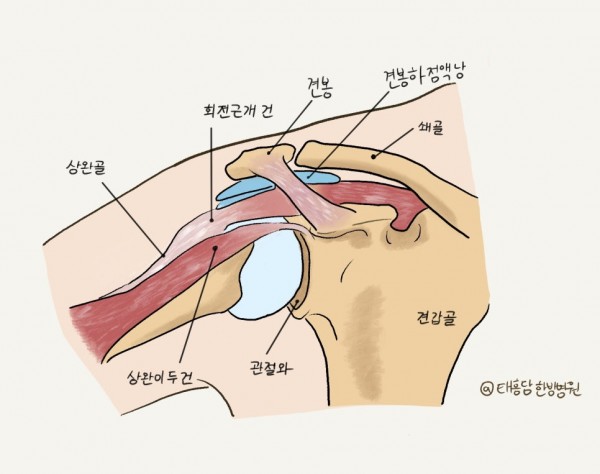 어깨 충돌 증후군