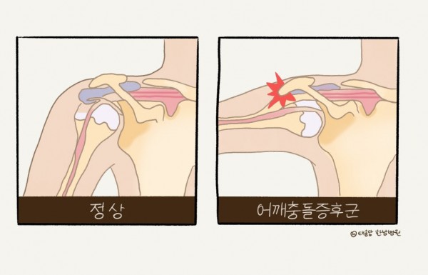 어깨 충돌 증후군