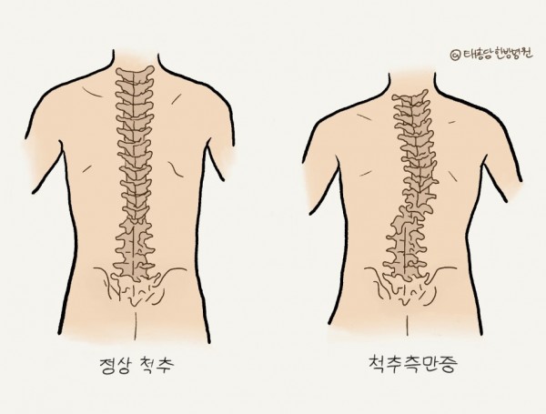 척추측만증