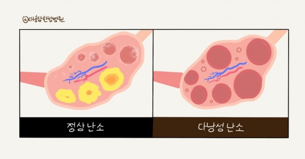 다낭성 난소증후군