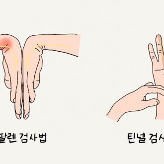 손목터널증후군 검사