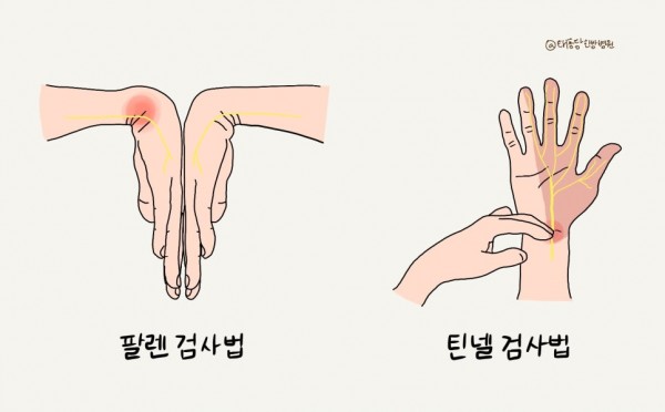 손목터널증후군 검사