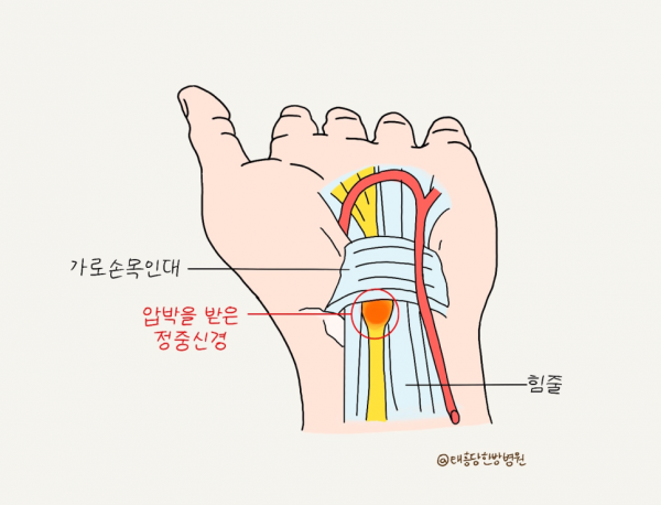 손목터널증후군