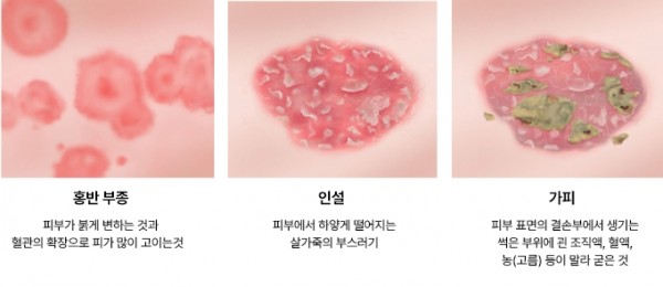 지루성 피부염