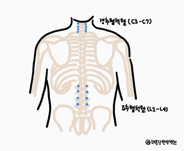 수족냉증 수족다한증