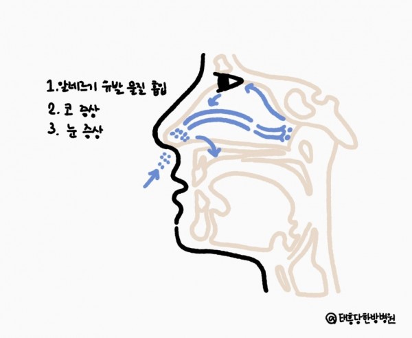 소아 어린이 비염