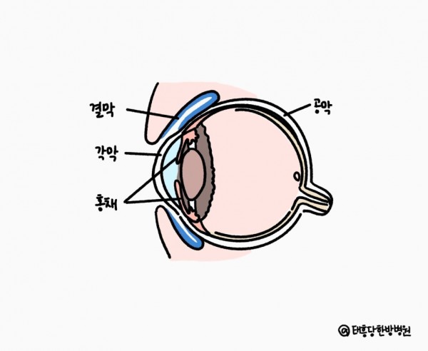알레르기 결막염