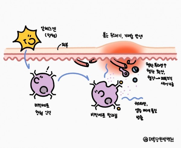 알레르기 두드러기