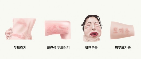 알레르기 두드러기