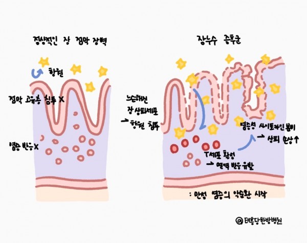만성피로 장누수증후군