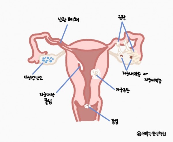 난임의 원인 질환
